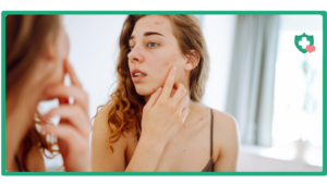 Does Tirzepatide Cause Acne
