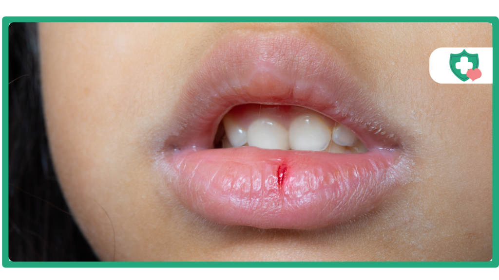 Mounjaro Dry Mouth Causes and Solutions