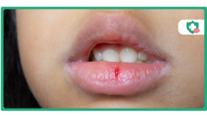 Mounjaro Dry Mouth Causes and Solutions